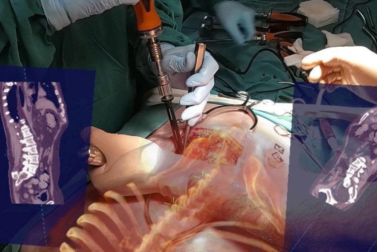 3D augmented reality surgical navigation system achieves FDA approval for precision spine surgery