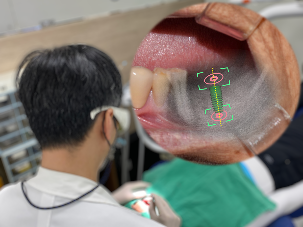 Accuracy of Augmented Reality–Assisted Navigation in Dental Implant Surgery: Systematic Review and Meta-analysis