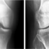 Artificial Intelligence Searches an Early Sign of Osteoarthritis from an X-ray Image