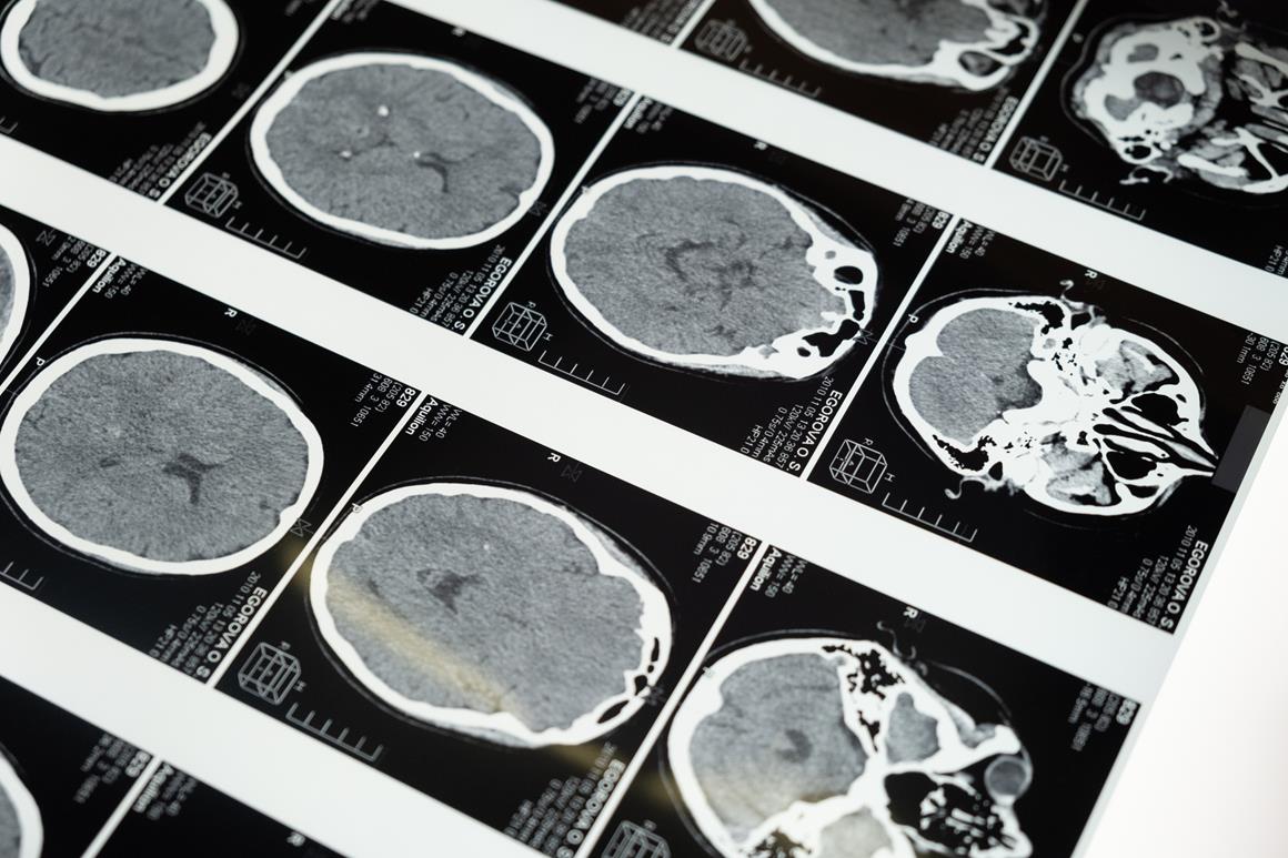 How old is your brain, really? Artificial intelligence knows - Press Room USC