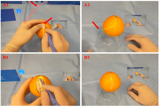 J. Imaging | Free Full-Text | Remote Interactive Surgery Platform (RISP): Proof of Concept for an Augmented-Reality-Based Platform for Surgical Telementoring