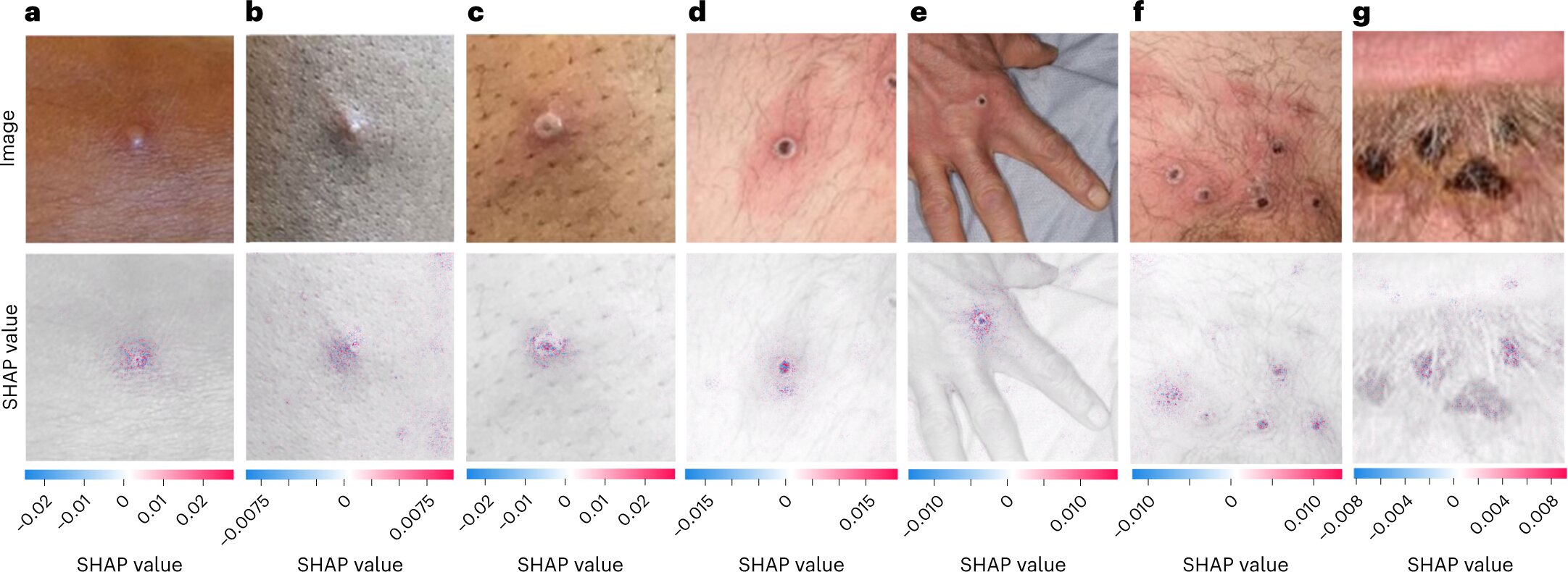 App recognizes suspected mpox rashes using artificial intelligence
