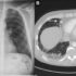 Artificial Intelligence 'Can Help Spot Early Signs of Cancer in Chest X-Rays'